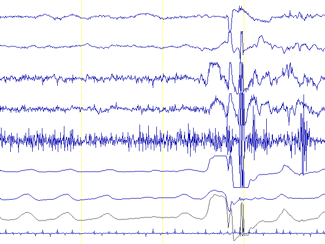 polygraph-eeg-tracing[1].gif